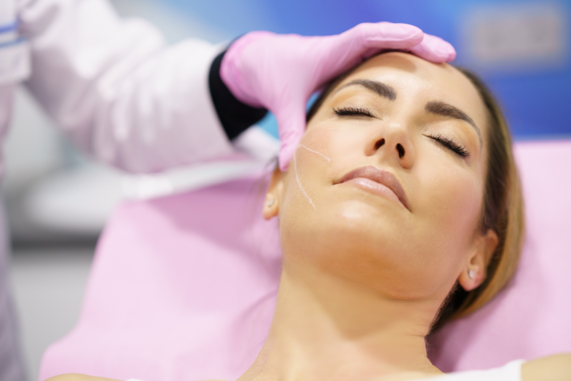 Doctor painting the area of a woman's face where the PDO suture treatment threads will be